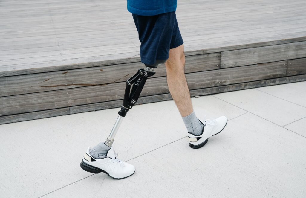 amputee injury victim with prosthetic leg