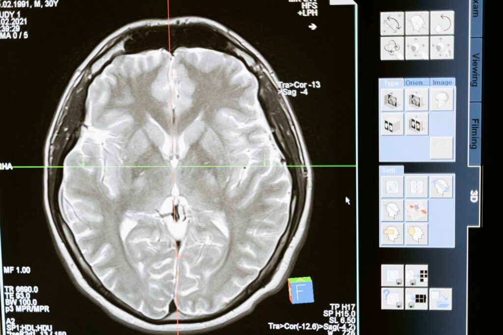 brain injury CT Scan 