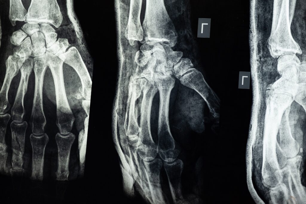 x-ray broken bones work injury illinois